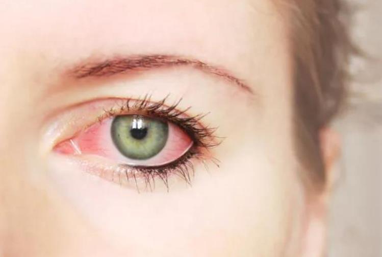 眼睛发炎吃什么水果有助于消炎？