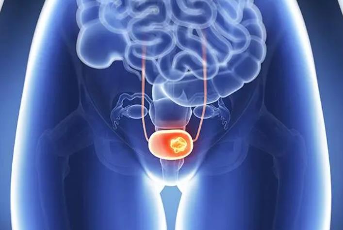 男性膀胱炎的症状有哪些，日常如何预防？